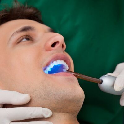 Xwusaf80cvr5zqyjb2k3 Dental Bonding Procedure